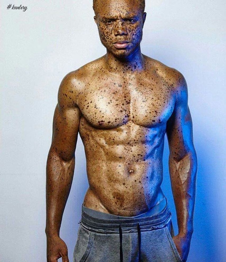 Freckles Took Him From Being Bullied To Being A Super Model; Meet Ralph Souffrant